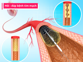 Stent mạch vành là gì? Có những loại stent nào?